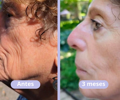 Vitalia® - BOTOX Reduzca las arrugas inmediatamente