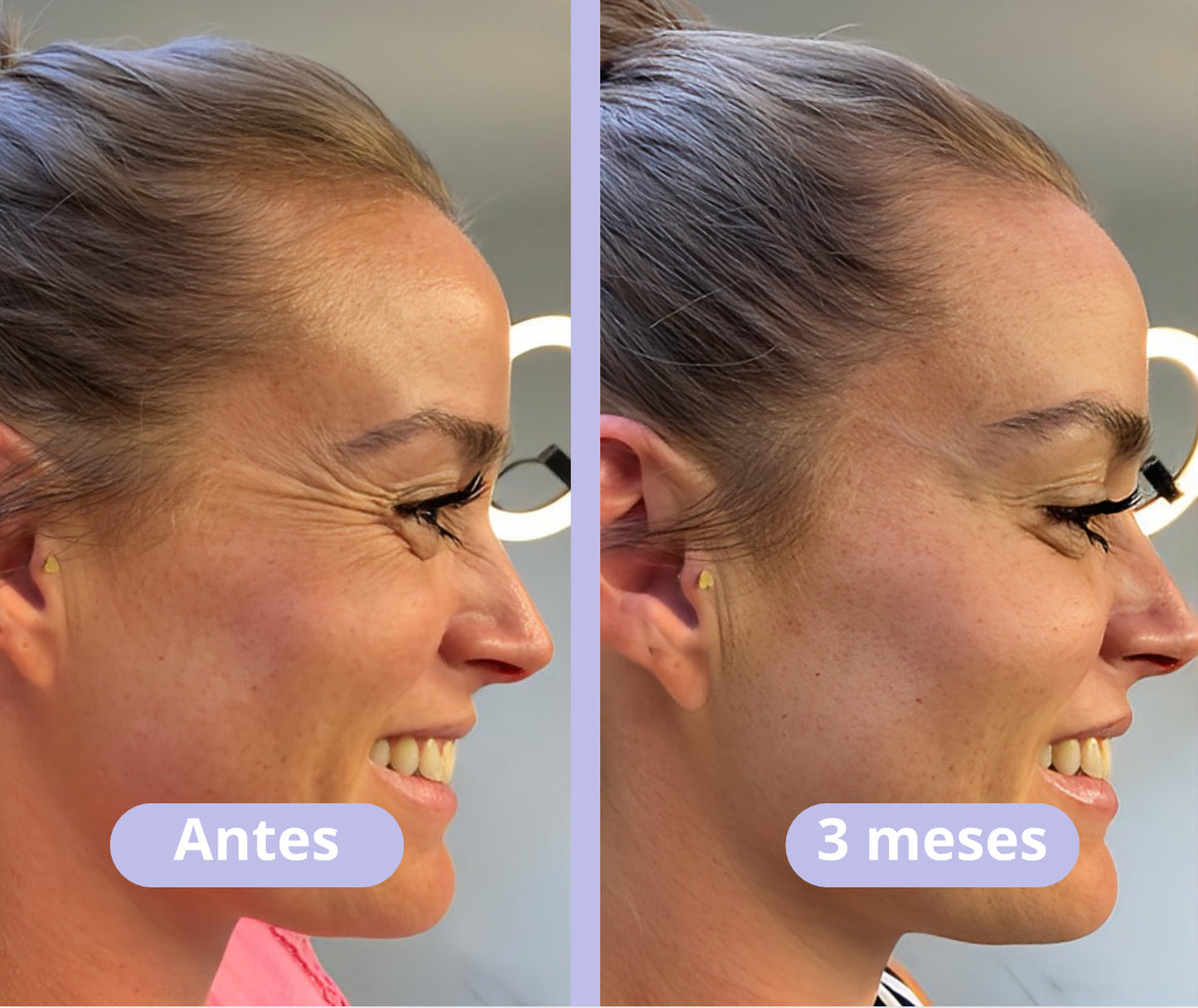 Vitalia® - BOTOX Reduzca las arrugas inmediatamente