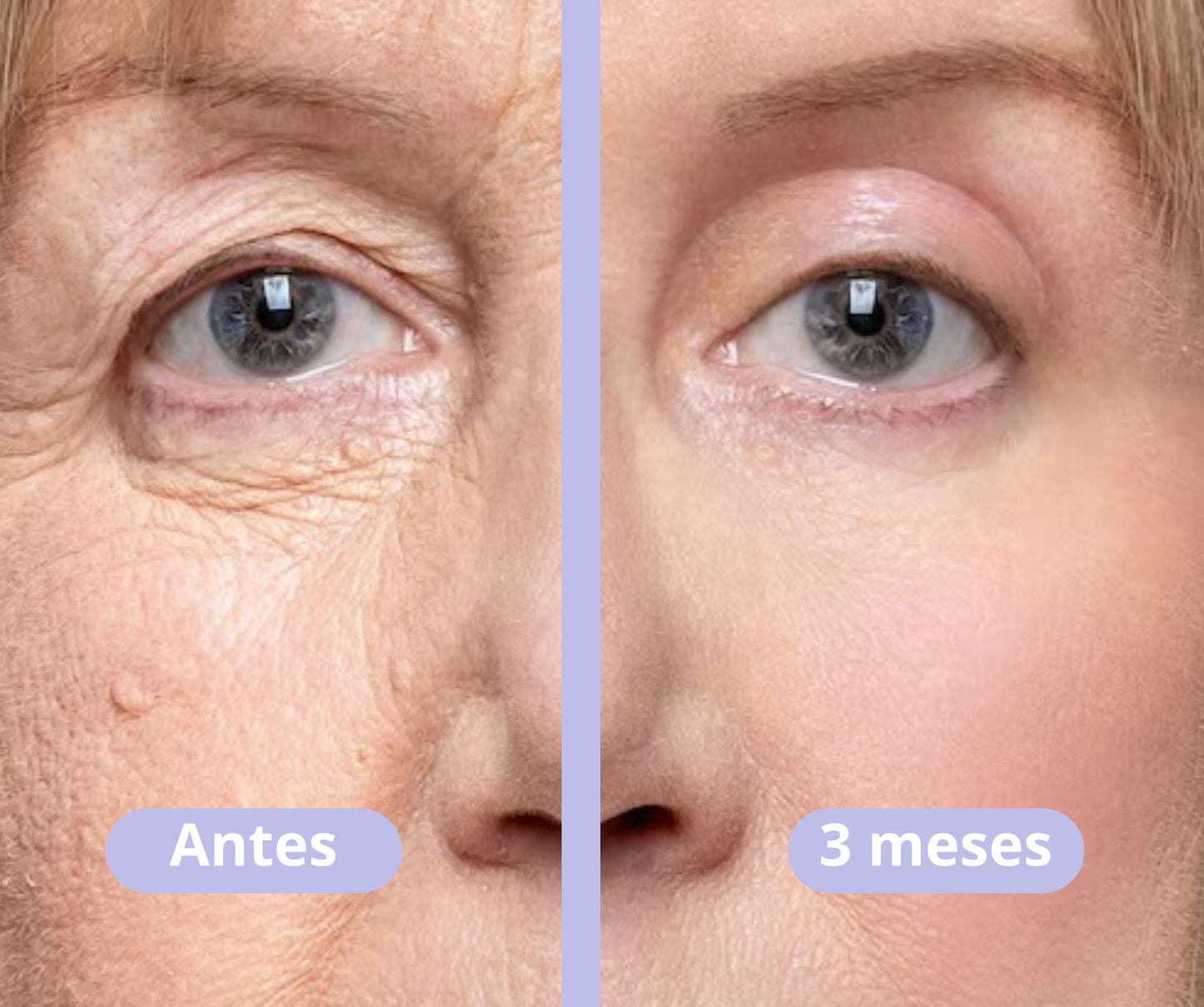 Vitalia® - BOTOX Reduzca las arrugas inmediatamente