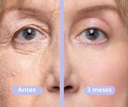 Vitalia® - BOTOX Reduzca las arrugas inmediatamente